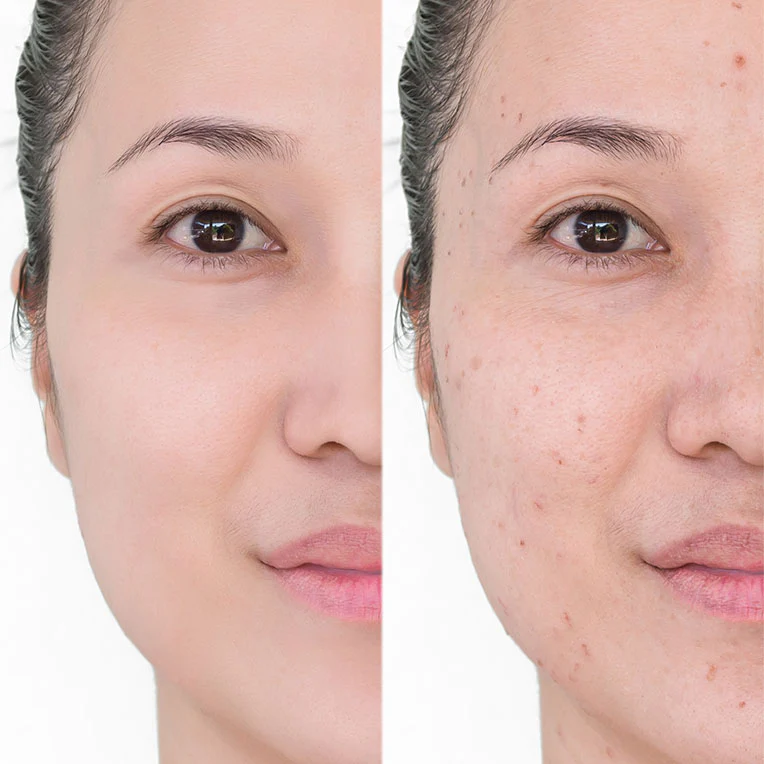 Morpheus8 RF Microneedling