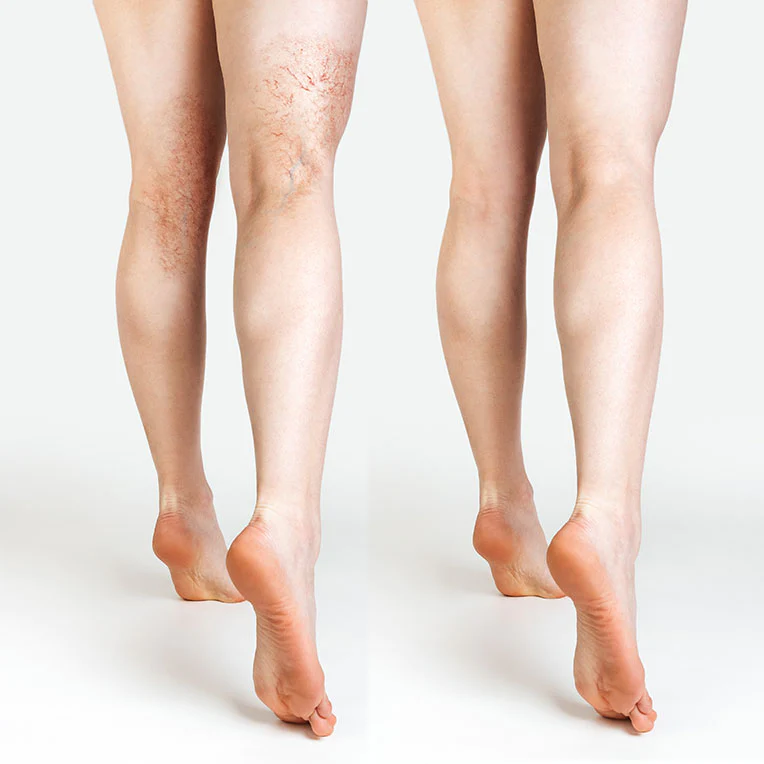 Lumecca IPL by InMode