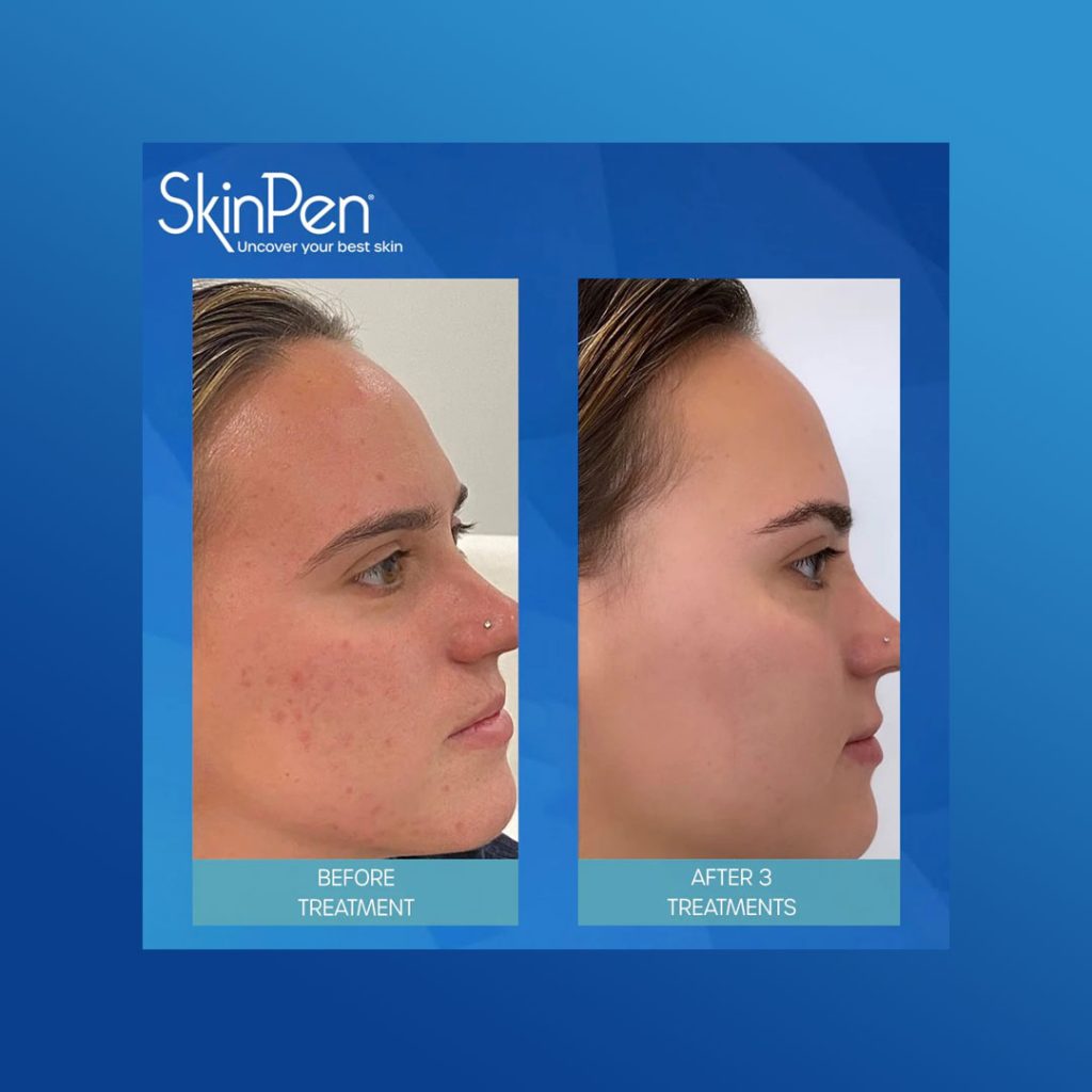 SkinPen Microneedling