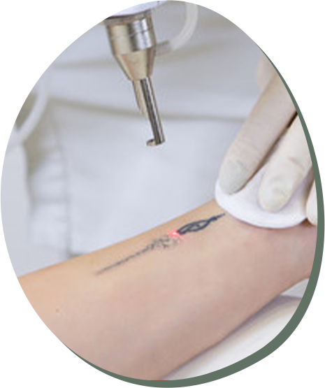 TATTOO REMOVAL